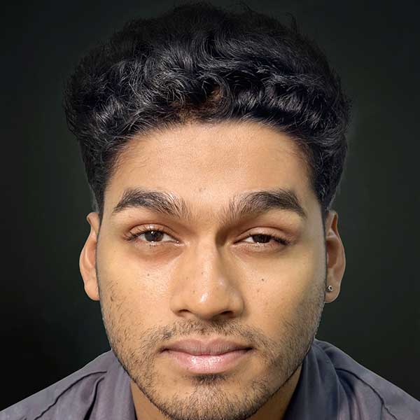Botox Treatment