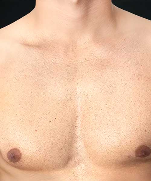 Laser Hair Removal