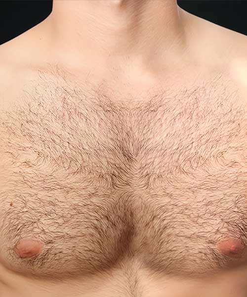 Laser Hair Removal