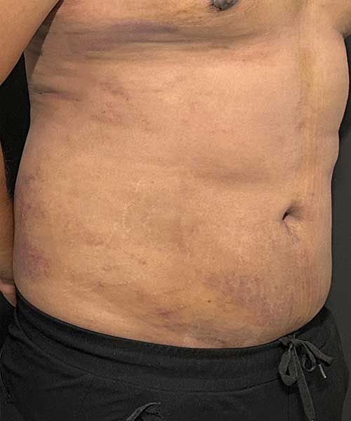 Liposuction