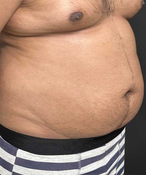 Liposuction