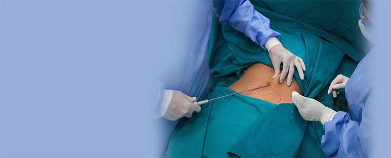 Liposuction