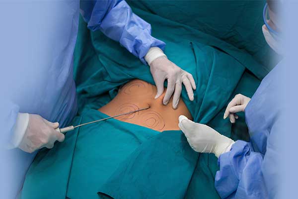 Liposuction