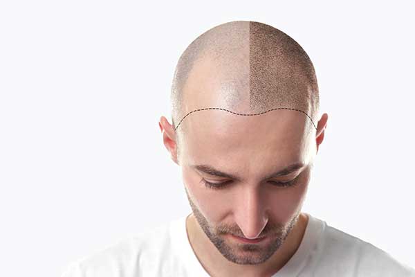 Hair Transplant in Bangladesh | Este Aesthetic Hospital